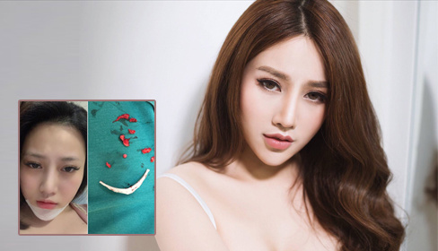 Filler tiêm 4 năm không tan, 9X Hà Nội sưng vù cằm, ăn uống khó khăn - Ngôi sao